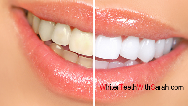 Natural Teeth Whitening